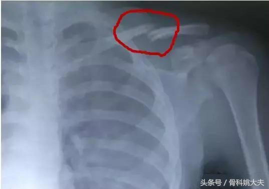 锁骨骨折三个月手臂抬不起来,锁骨骨折三个月手臂抬不起来，恢复过程中的挑战与应对策略